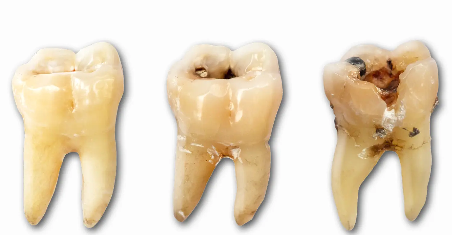 Caries 2